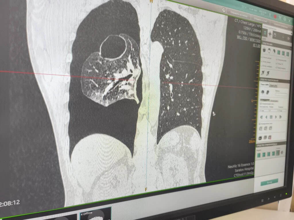 Саратовец пришёл к медикам на консультацию и случайно узнал об опасной патологии